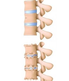 healthy spine and spine are affected by bone necrosis