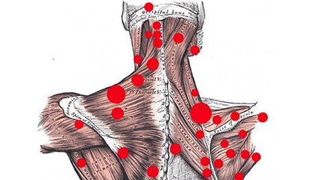 Trigger points in the muscles that cause back nerve pain