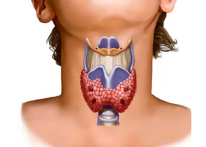 Thyroid problems are the cause of neck pain