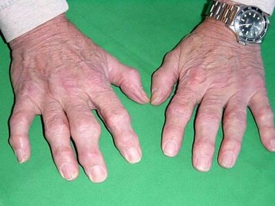 Finger arthritis