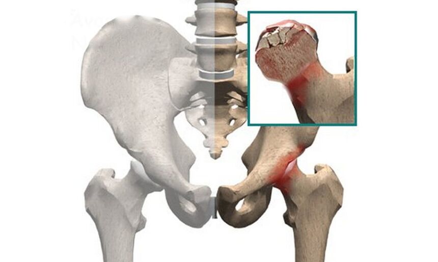 Femoral head necrosis is one of the causes of hip pain