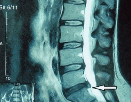 protrusion of the spinal disc during an MRI scan