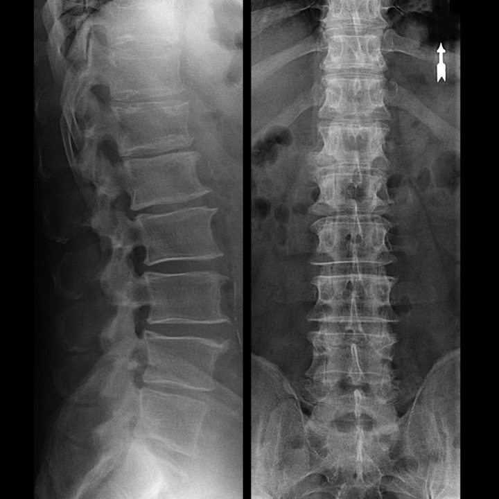 vertebral cartilage degeneration on X-ray