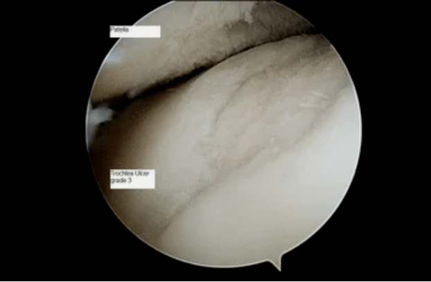 Astrological image of knee joint with grade 3 osteoarthritis