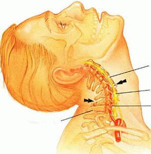 Cervical spine degeneration